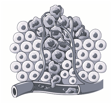 Image 1: Tumor Cells and Vessel